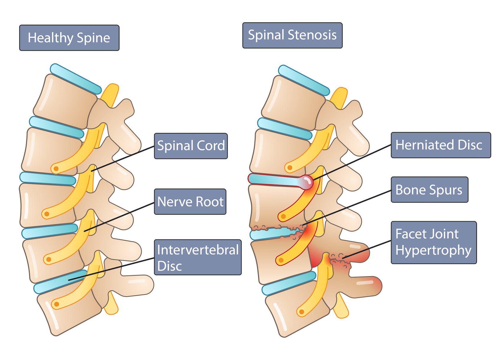 Lumbar Spinal Stenosis