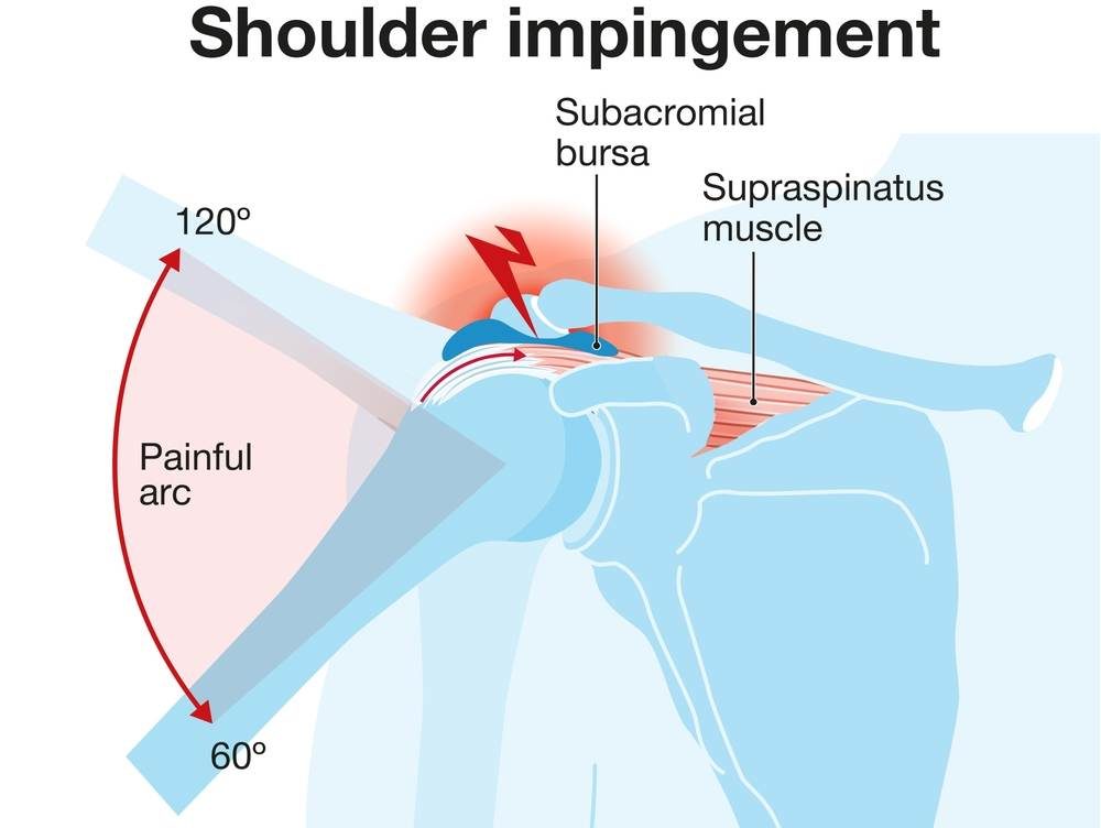 อาการปวดไหล่ขณะกางแขน หรือ Shoulder Impingement Syndrome